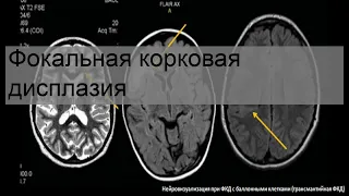 Фокальная корковая дисплазия