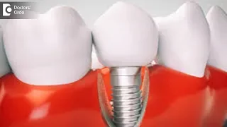 Do Dental Implants release metal inside the body? - Dr. Arundati Krishnaraj
