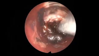 Spontaneous intracerebral hemorrhage