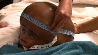 From despair to hope for Indian girl with swollen head