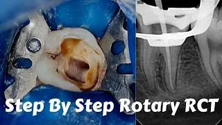 Live Steps Root Canal Rotary Protaper Endodontic Procedure  ACP, BMP, obturation, irrigation
