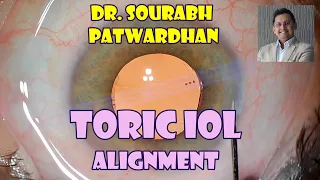 134 Toric IOL alignment Dr Sourabh Patwardhan