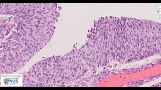 Renal pelvis: Invasive urothelial carcinoma Microscopy  - Talking slide