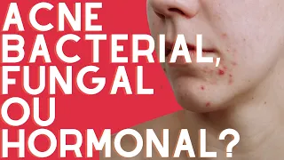 Sua Acne é de Origem HORMONAL? | Aprenda a identificar os sinais e como você pode tratar ❣️