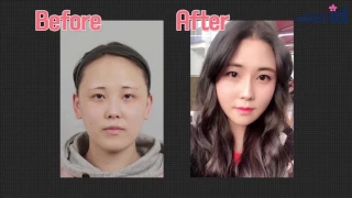 Korean girl undergoing v line surgery, cheekbone reduction, and hairline surgery!