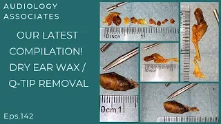 OUR LATEST EAR WAX/Q-TIP REMOVAL COMPILATION - EP 142