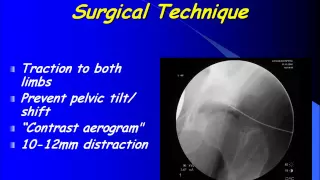 Arthroscopic Diagnosis & Treatment of Septic Arthritis of the Hip