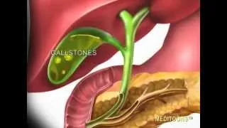 Acute Cholecystitis (Gallbladder Attack) Meditoons™