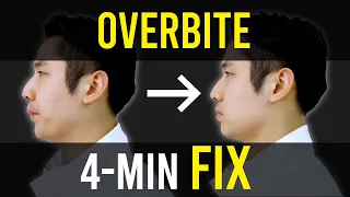 Overbite & Overjet Fix｜Facial Asymmetry Correction｜Corrective Exercises