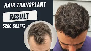 Hair Transplant Result 3200 grafts l Before and After 12 months l Hair Transplant in Turkey