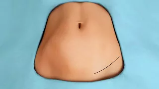 Tummy Tuck Animation