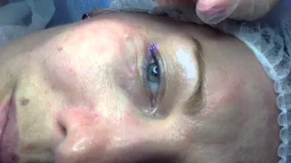 Биоревитализация увлажнение кожи, заполнение морщин область вокруг глаз  носогубная складка