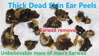 TOTAL OBSTRUCTION : EAR WAX REMOVAL : FULLHD | 2023-11 EP1 #relaxing #satisfying #asmr