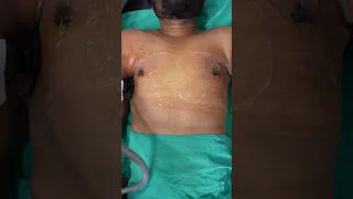 Manboobs surgery result | Dressing removal & RF Session #shorts