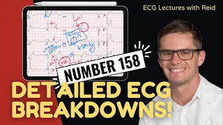 Live ECG interpretations | Number 158