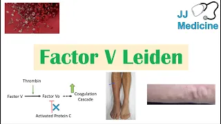 Factor V Leiden | Causes, Pathophysiology, Symptoms, Diagnosis, Treatment