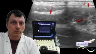 Pediatric abdominal ultrasound - Ileotiphlitis and mesadenitis