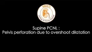 Supine PCNL : Pelvis perforation due to overshoot dilatation