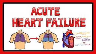 Acute Heart Failure -  Types of Acute Heart Failure | Causes | Signs and Symptoms