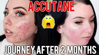 MY ACCUTANE JOURNEY 2 MONTH UPDATE Before & After, Side Effects, Skin Care Products I'm using!