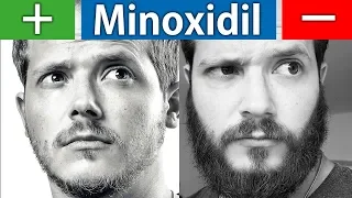 Die Vor und Nachteile von Minoxidil | Kurz und Knapp