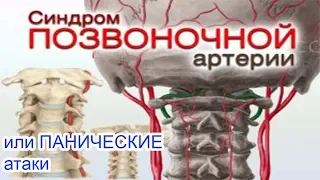 Синдром позвоночной артерии или паническая атака Головокружение Лечение Харьков Днепр