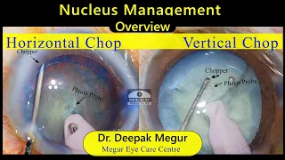 Phaco Basics-Nucleus management pearls & pitfalls - Dr Deepak Megur