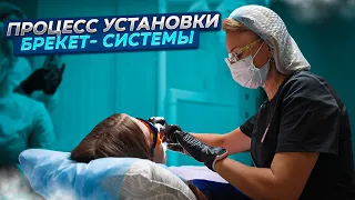 Установка брекетов в Сочи. Исправление перекрестного прикуса. Брекет-система damon q. Студия Улыбок.