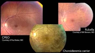 Infectious Posterior Uveitis