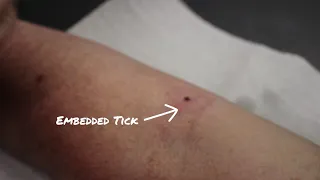 Removing a Tick