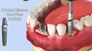 Zimmer One Piece Implant