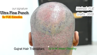 `best quality fue hair transplant surgery with ultra fine punch