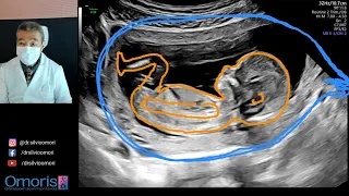 Let's find out the SEX OF THE BABY! Pregnancy 13 weeks.