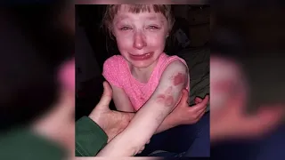 10-year-old girl with special needs ‘brutally’ bitten on school bus, parents say