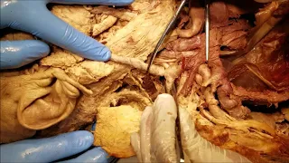 Lateral Neck Muscles External Jugular Vein Cervical Plexus Clinical Demonstration – Sanjoy Sanyal