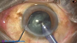 Phacoemulsification of cataract with grade 2 NS- totally unedited: Pradip Mohanta, 2 Dec, 2023