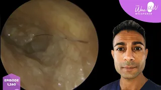 1,260 - Very Complex & Challenging Ear Cleaning Video