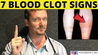 7 Warning Signs of a BLOOD CLOT (Symptoms) 2024