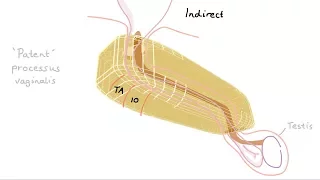 How do we get inguinal hernias?