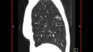 Lung Anatomy: Bronchoalveolar Cell Carcinoma (1 of 3)
