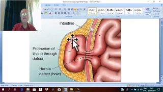 Hernia in English 2 ( External  abdominal hernia , part 1) , by Dr. Wahdan .