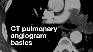 Pulmonary CT Angiogram Basics