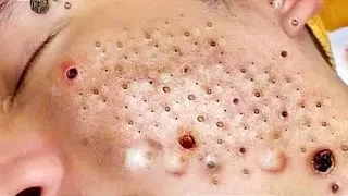 Start New Life with Blackheads removal  Acne Sac dep spa treatment