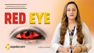 Red Eye | Episcleritis | Ophthalmology Video Lectures | Medical Education | V-Learning