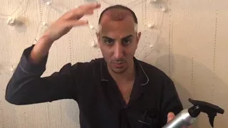 Hair Transplant Blog Day 1