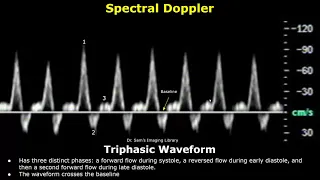 Monophasic, Biphasic & Triphasic Spectral Doppler Waveforms | Vascular Ultrasound Analysis (USG)