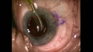 Phacoemulsification: OVD (Viscoelastic) Removal