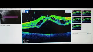 RETINAL DETACHMENT SURGERY