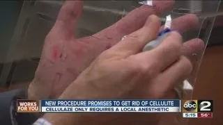 New plastic surgery treatment gets rid of cellulite