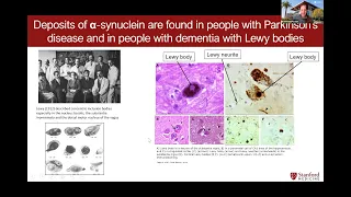 Parkinson’s disease and dementia with Lewy Bodies:Biological definition
